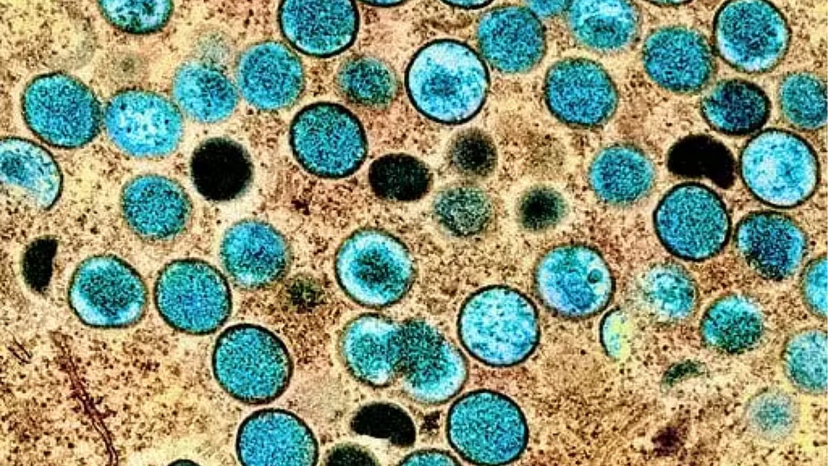Thailand Reports 1st Case Of Monkeypox; Africa To Begin Vaccinations Soon  - | Photo: World Health Organisation